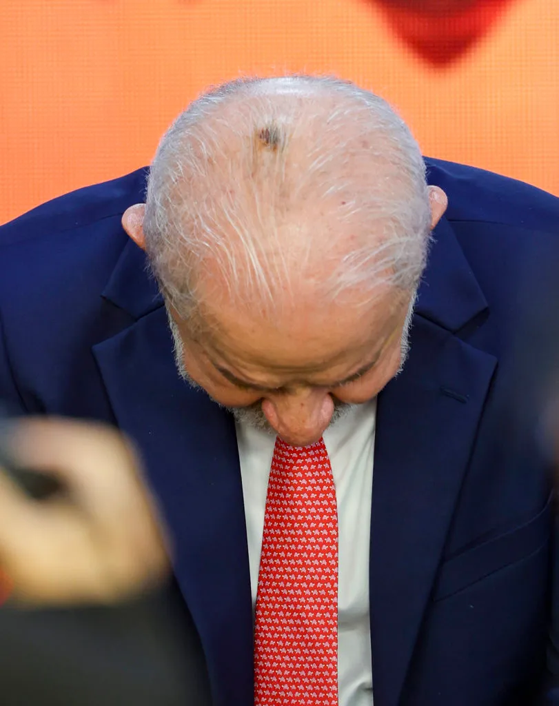 Imagem de Lula aparece com marca na cabeça após procedimento dermatológico
